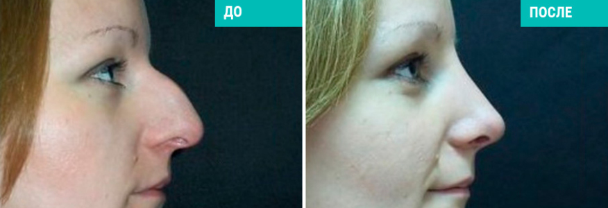 Ринопластика