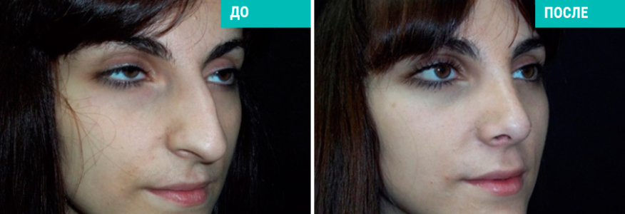 Ринопластика