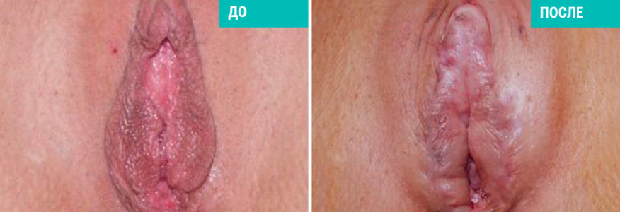 Лабиопластика, фото сразу после операции