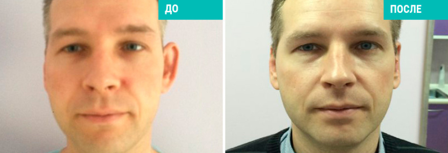 Отопластика