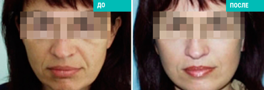 Фейслифтинг