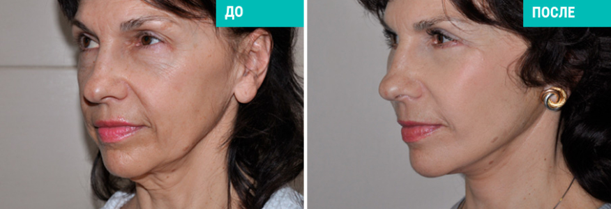 Фейслифтинг