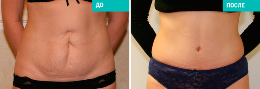 Абдоминопластика