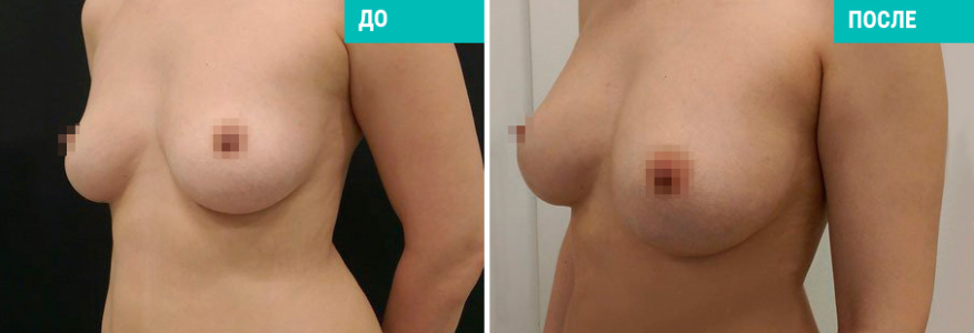 Липофилинг груди