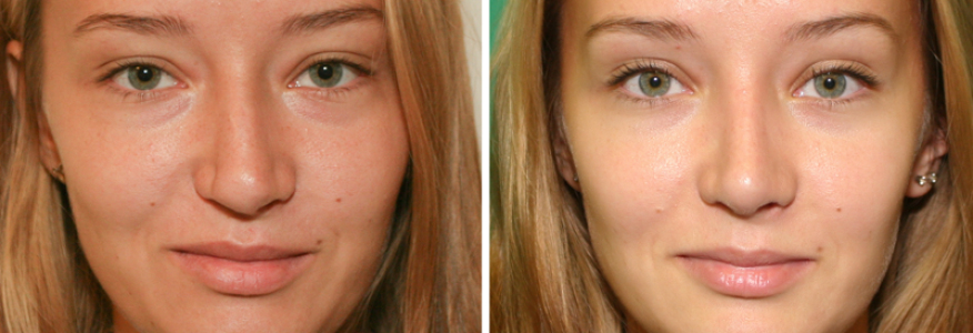 Ринопластика 