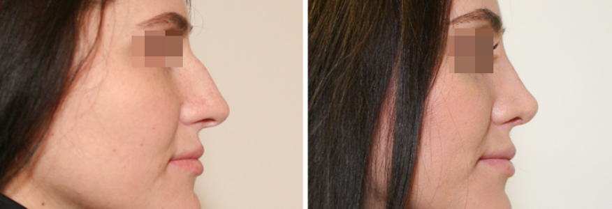 Ринопластика 