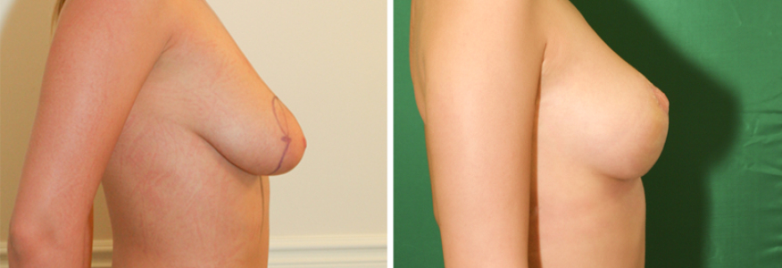 Мастопексия без имплантов