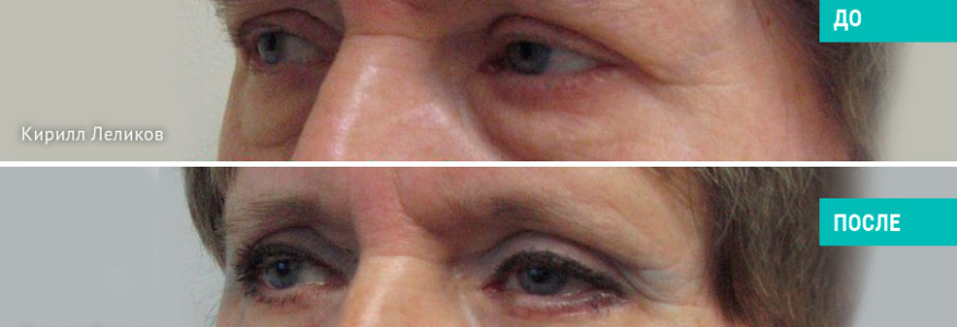 Выполнена верхняя и нижняя блефаропластика с контомиопексией