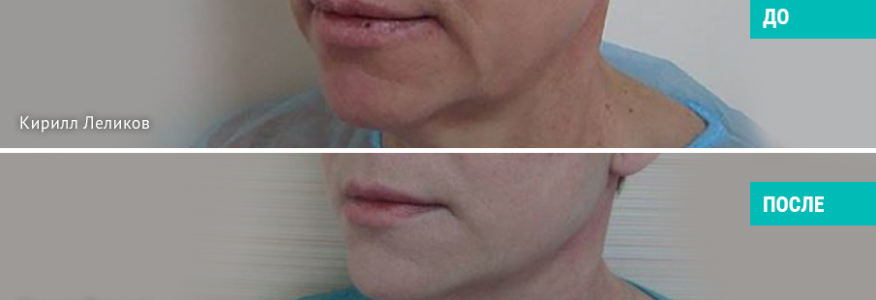 Пациентке  проведена пластика лица со SMAS. Результат спустя 2 года