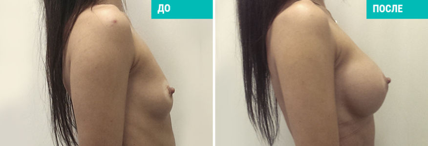 Увеличение груди