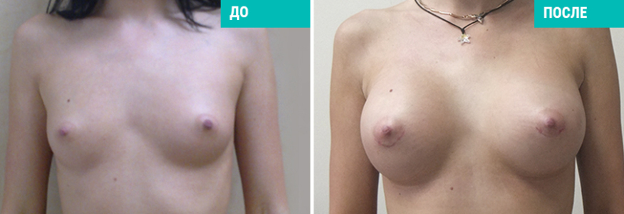Увеличение груди