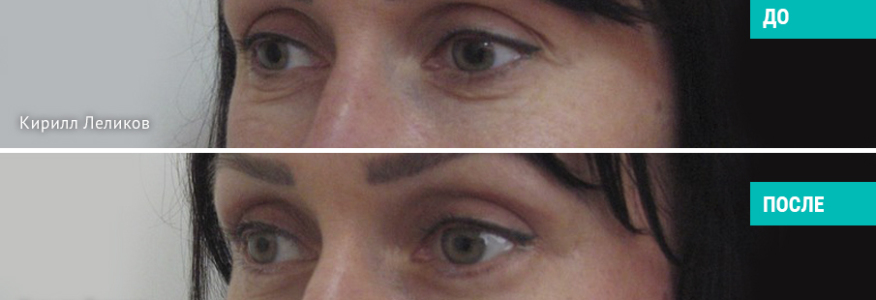 Круговая блефаропластика. Спустя 2 месяца.