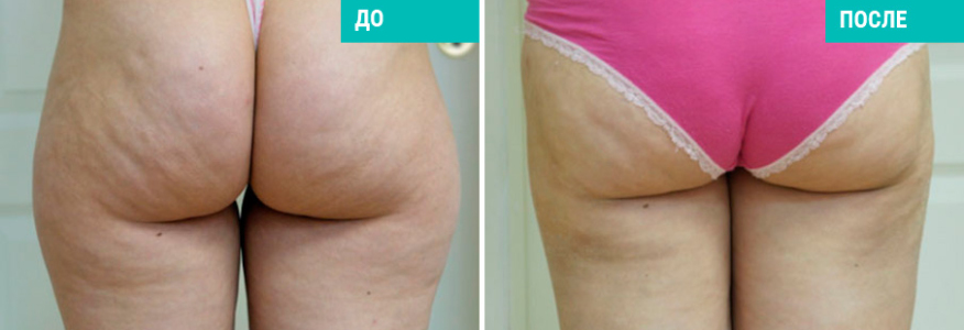 Липосакция