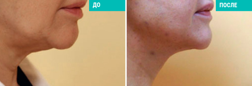 Липосакция подбородка