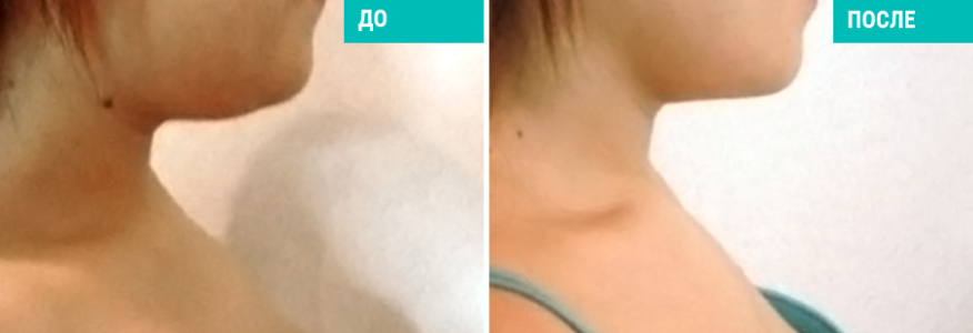 Липосакция подбородка 