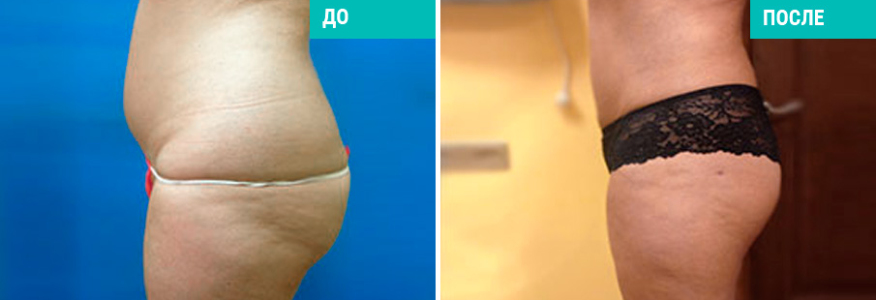 Липосакция