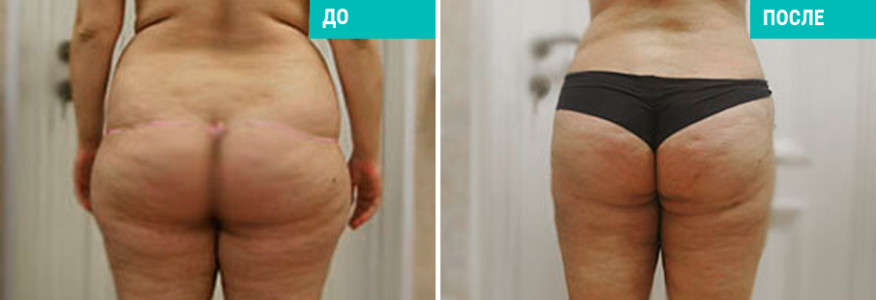 Липосакция