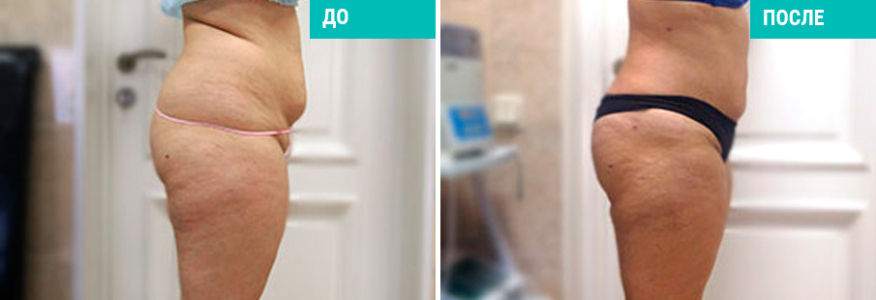 Липосакция