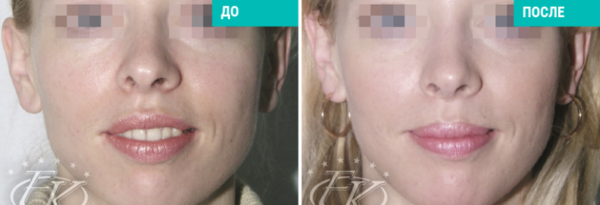 Исправление профиля