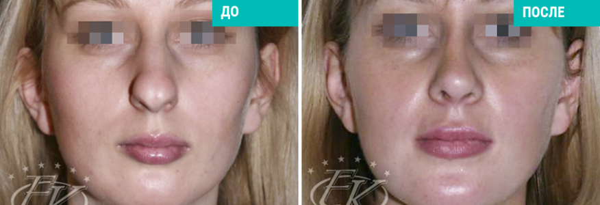 Исправление профиля