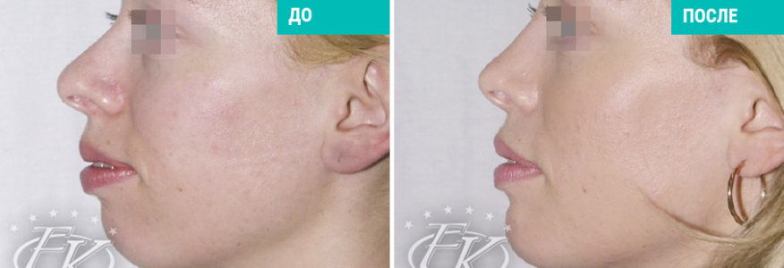 Исправление профиля