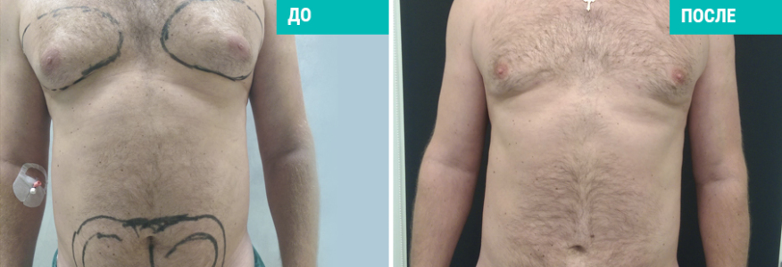 Vaser-липосакция