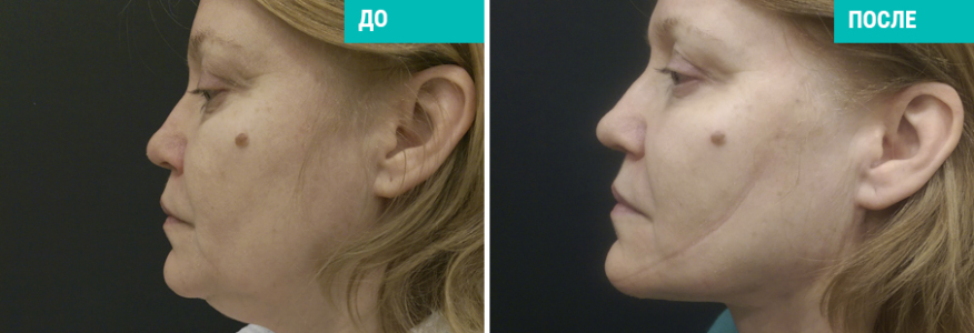 Vaser-липосакция 