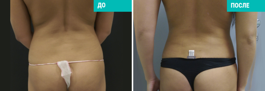 Vaser-липосакция