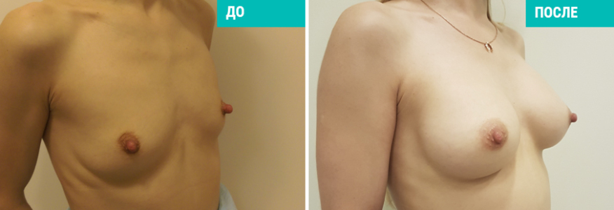 Маммопластика