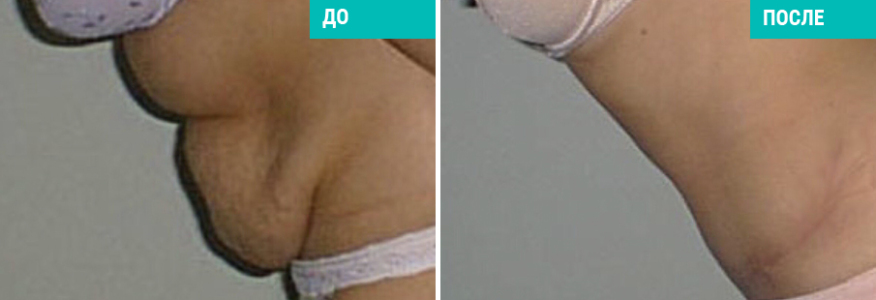 Абдоминопластика