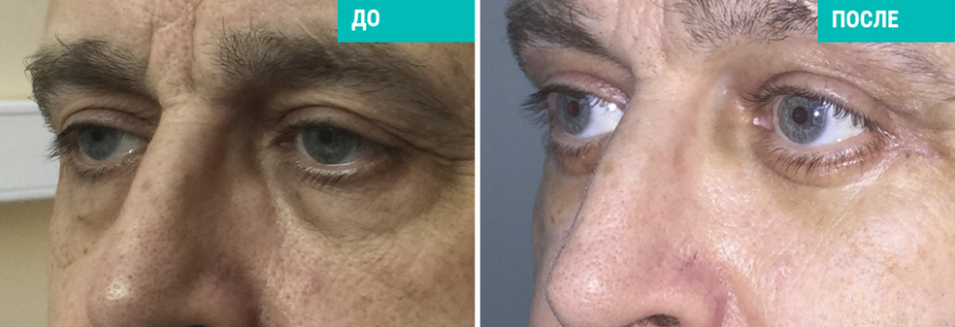 Блефаропластика