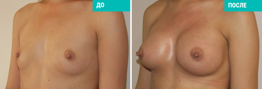 Увеличение груди
