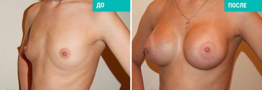 Увеличение груди