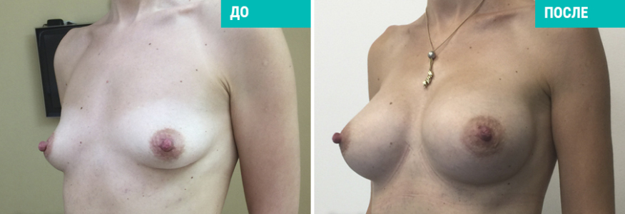 Увеличение груди