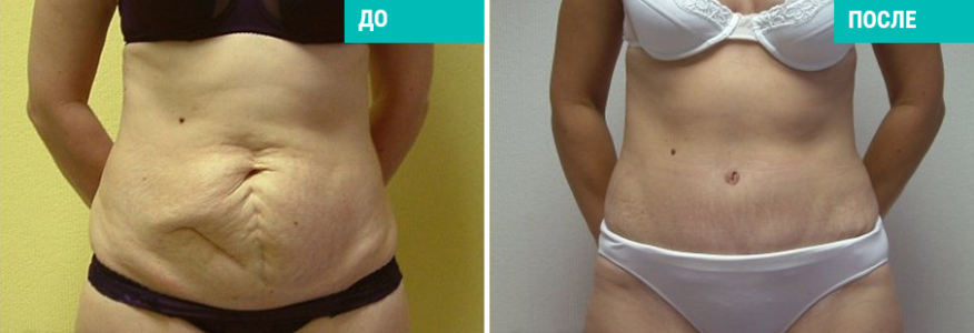 Абдоминопластика