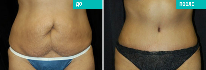 Абдоминопластика