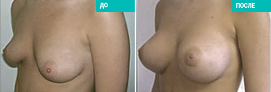 Увеличение груди