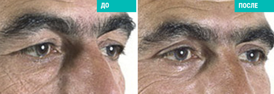 Блефаропластика