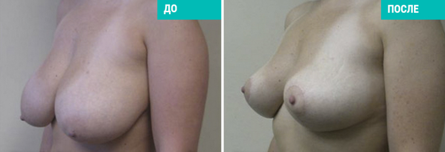 Уменьшение груди