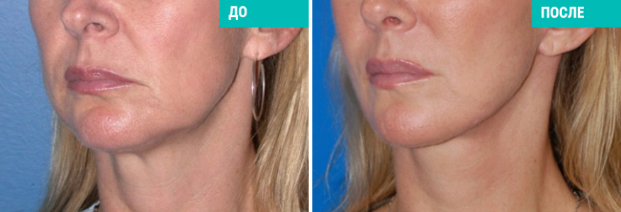 Нитевая подтяжка лица и шеи