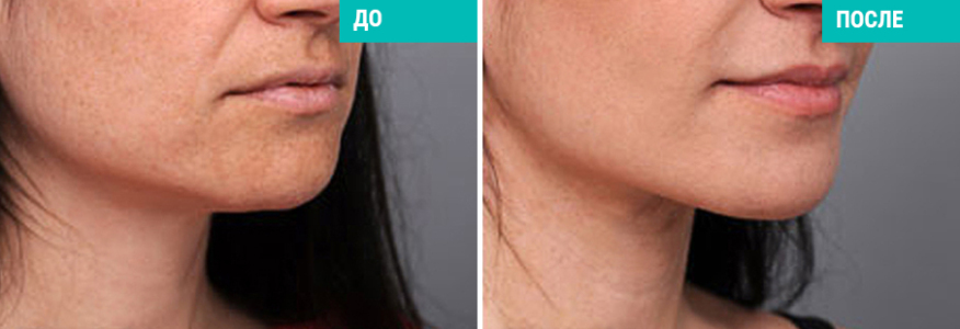 Нитевая подтяжка лица и шеи