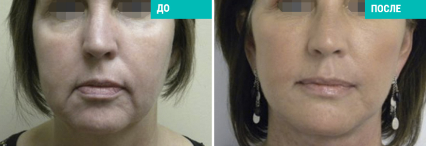 Фейслифтинг