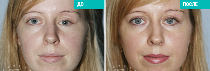 Реконструкция глазницы после травмы 
(автомобильная авария, восстановления дна глазницы)