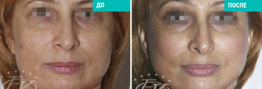 Подтяжка SMAS