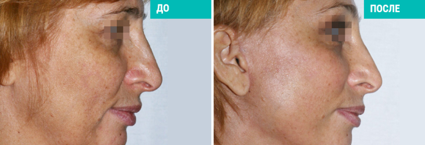 Подтяжка SMAS