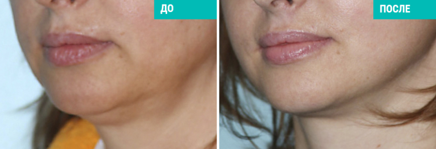 Подтяжка лица и шеи