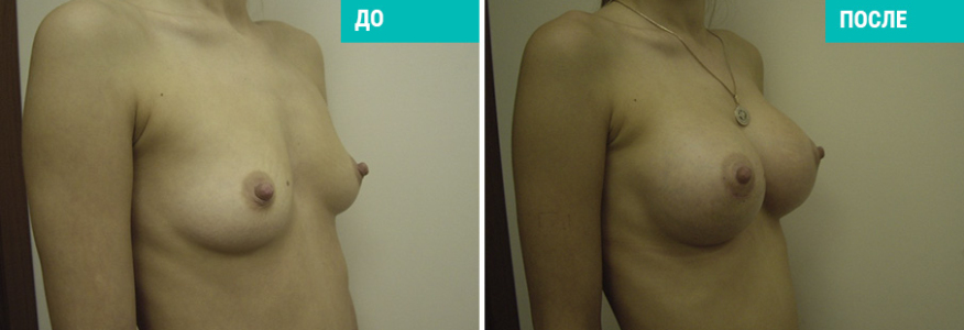 Увеличение груди