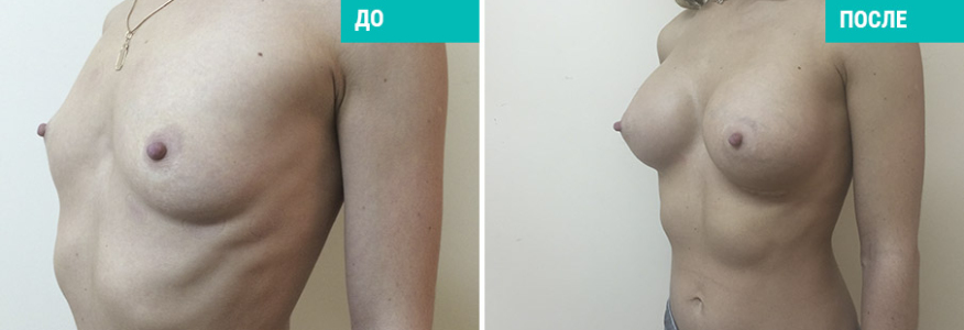 Увеличение груди