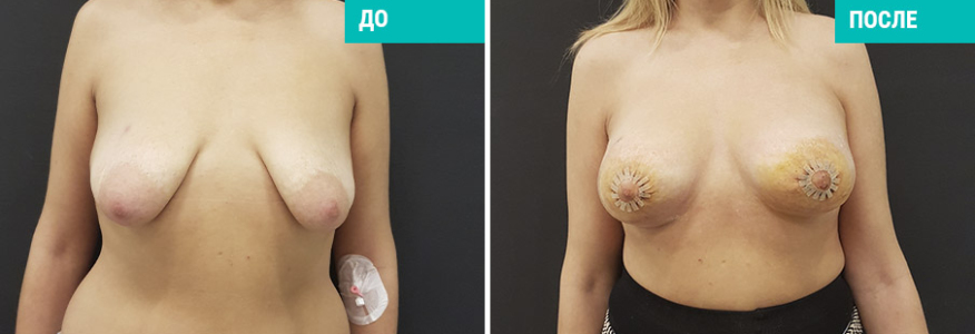 Маммопластика