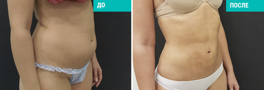 Вейзер липосакция